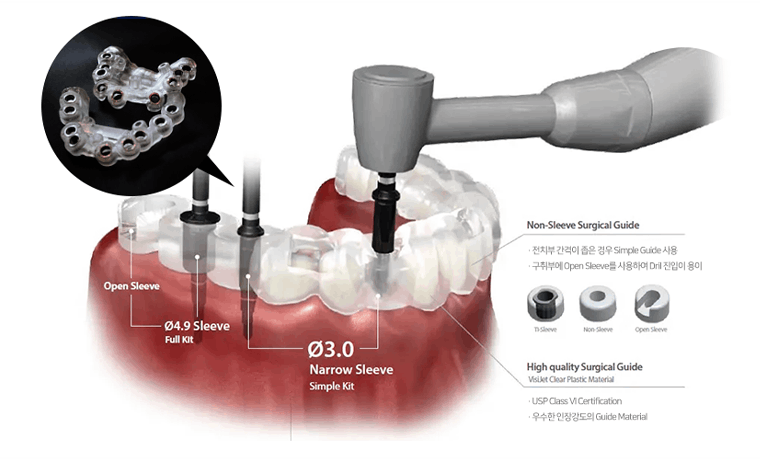 개인 맞춤형 수술 가이드