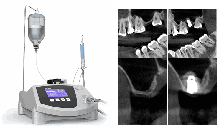 피에조 초음파 SURGYBONE PIEZO