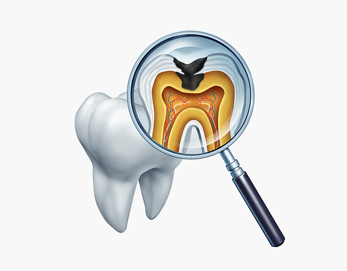 신경치료가 필요한 경우