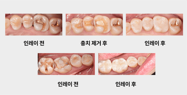 청담뷰 충치 치료 사례