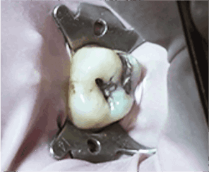 세렉 1DAY 충치 치료과정_01