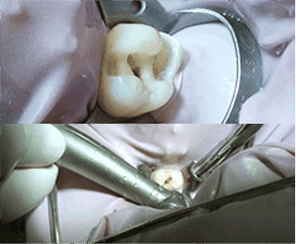 세렉 1DAY 충치 치료과정_02