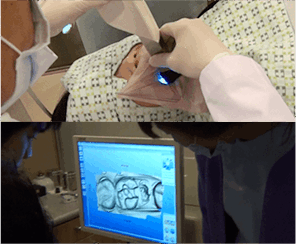 세렉 1DAY 충치 치료과정_03