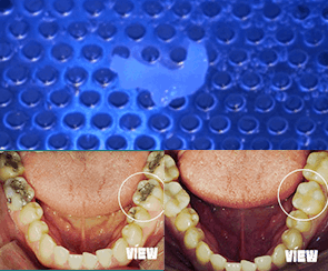 세렉 1DAY 충치 치료과정_04