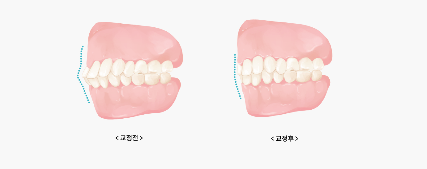 필요한 치아만 선택적으로 교정