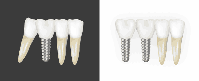 오래전 치아 제거한 자리로 기울어진 어금니