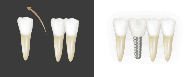 오래전 치아 제거한 자리로 기울어진 어금니
