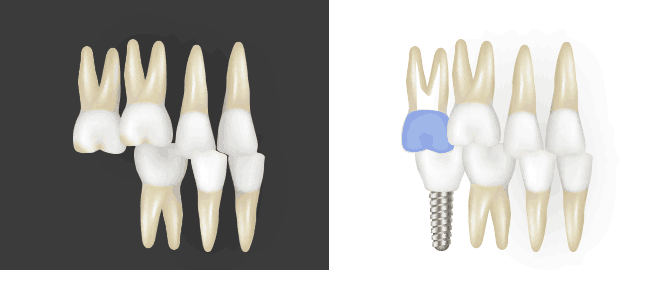 아래쪽 어금니를 제거한 자리로 정출된 위쪽 어금니 