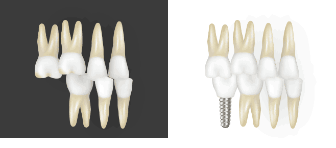 아래쪽 어금니를 제거한 자리로 정출된 위쪽 어금니 