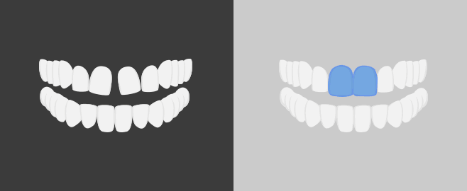 앞니 사이에 공간이 생긴 경우