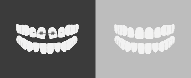 앞니 사이에 공간이 생긴 경우