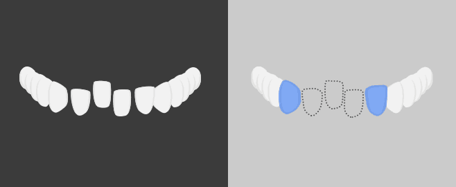 잇몸이 안좋아 아래앞니를 뺀 경우 