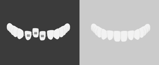 잇몸이 안좋아 아래앞니를 뺀 경우 