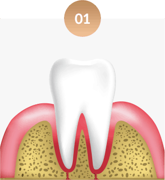 건강한 선홍빛 잇몸