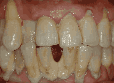 스케일링 치석제거 전