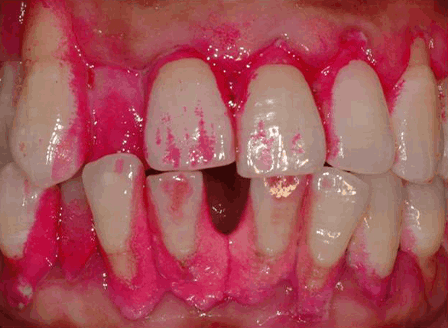 치면착색제 도포