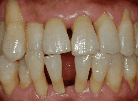 스케일링 치석제거 후