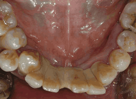 스케일링 치석제거 전