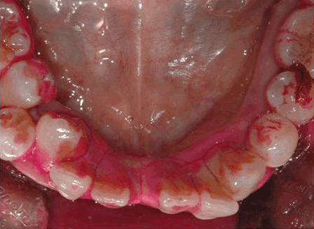 치면착색제 도포