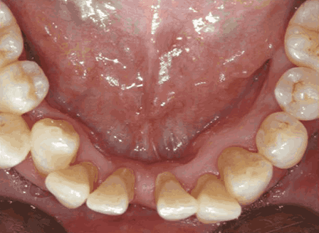 스케일링 치석제거 후