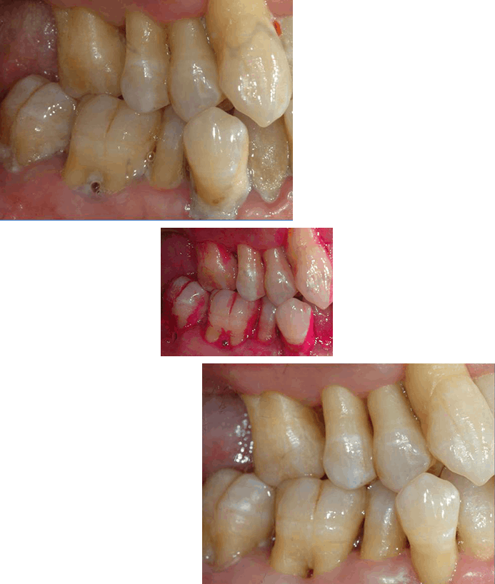 치주질환 자가진단방법