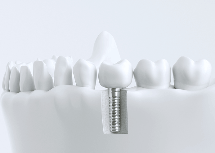 prf임플란트가 필요한 경우