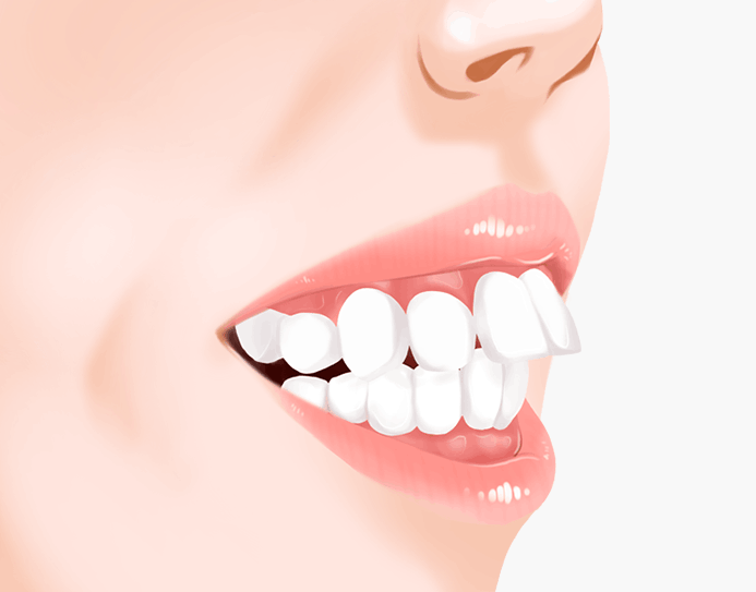 돌출입 치아교정