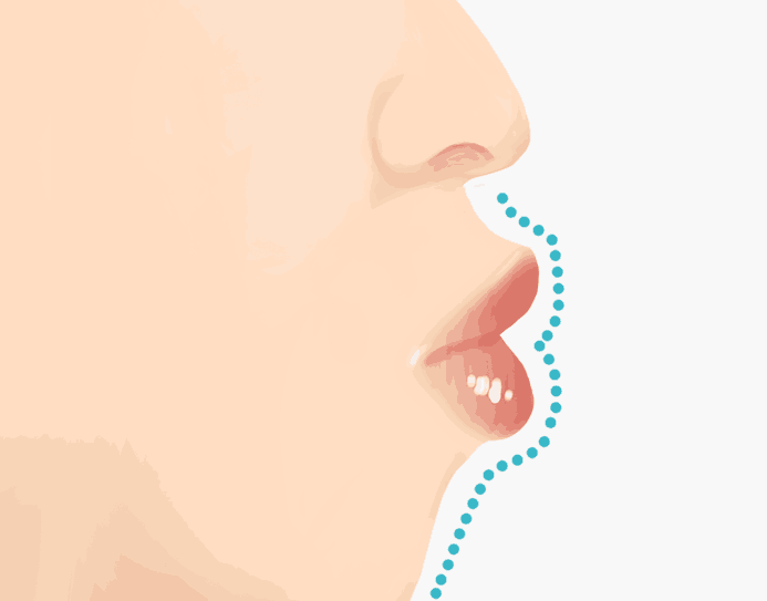 돌출입(돌출잇몸)