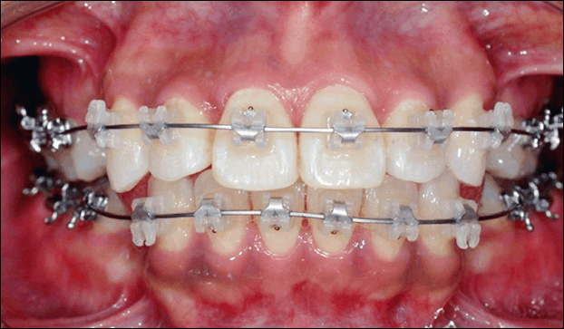 치아 교정기 장착, 칫솔질 교육