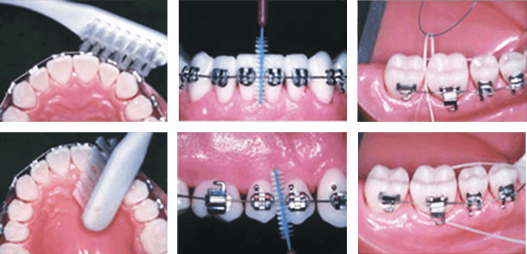 치아 교정기 장착, 칫솔질 교육