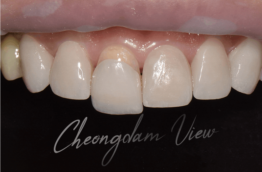 진심의 치아성형