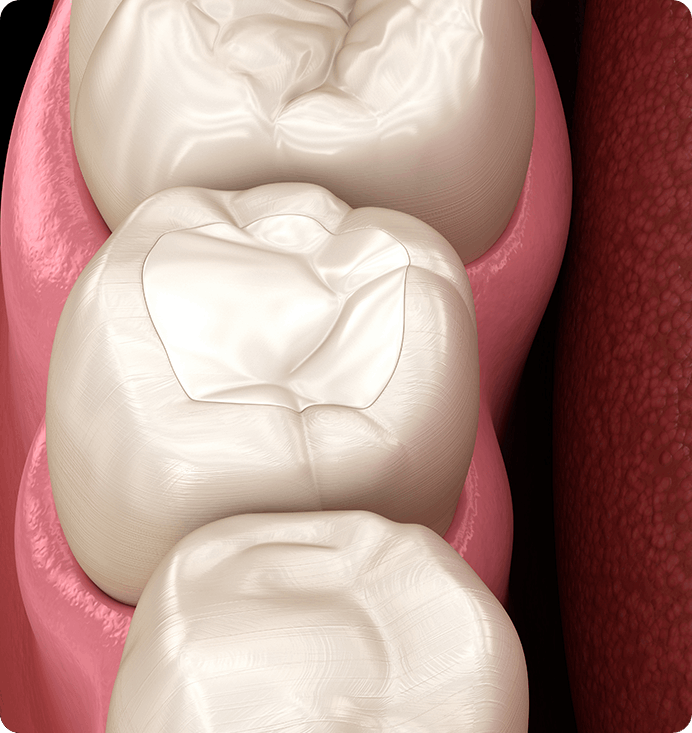 레진치료 적용범위