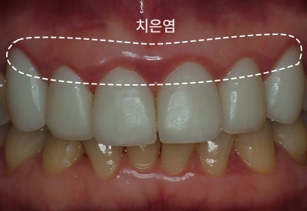 01. 불량 보철물로 인한 만성 치은염과 구취가 심한 상태