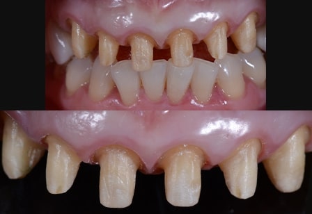 02. 기존 보철물을 제거하고 잇몸 치료 후 인상 채득을 합니다