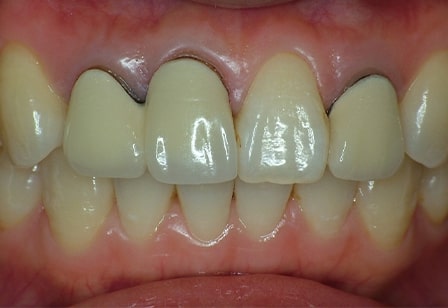 변색 및 색 부조화로 지르코니아 재시술 치아성형