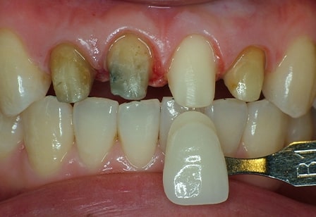 변색 및 색 부조화로 지르코니아 재시술 치아성형