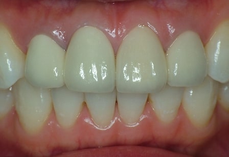 변색 및 색 부조화로 지르코니아 재시술 치아성형