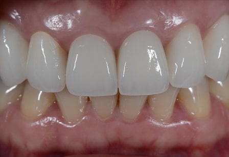 03. 지르코니아 크라운으로 재시술 치아성형 완료