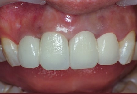 치아파절 재시술