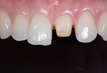 기존 크라운 탈락 후 지르코니아 크라운으로 재시술 치아성형