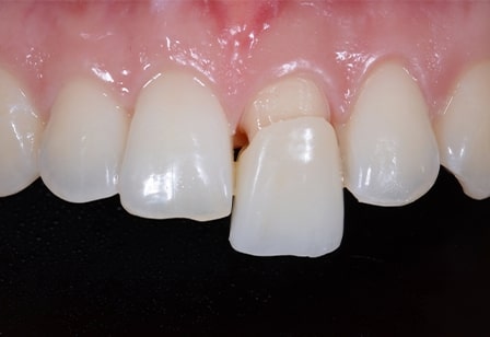 기존 크라운 탈락 후 지르코니아 크라운으로 재시술 치아성형