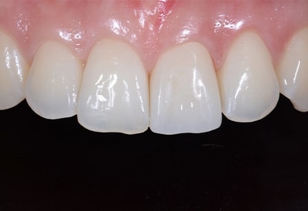 기존 크라운 탈락 후 지르코니아 크라운으로 재시술 치아성형