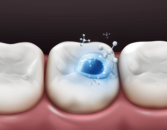 세렉 충치치료 이런 분들께 추천합니다.