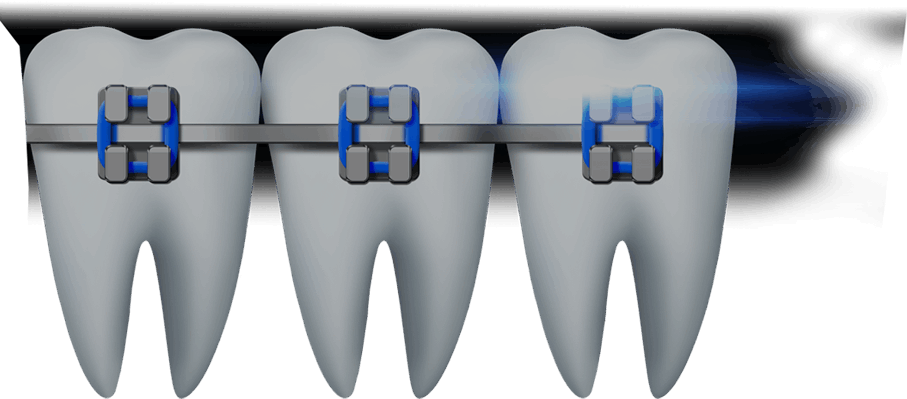 치아교정 인트로이미지
