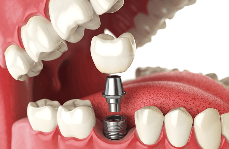 최소 침습 수술