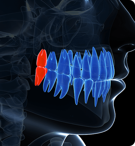 사랑니 발치 장점