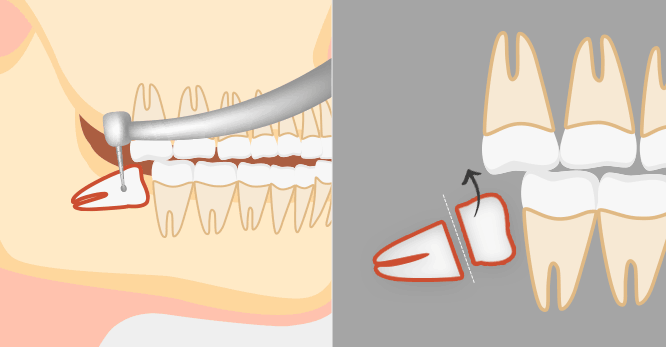사랑니 발치 치료방법