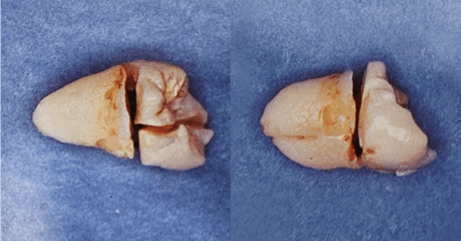 사랑니 발치 치료방법