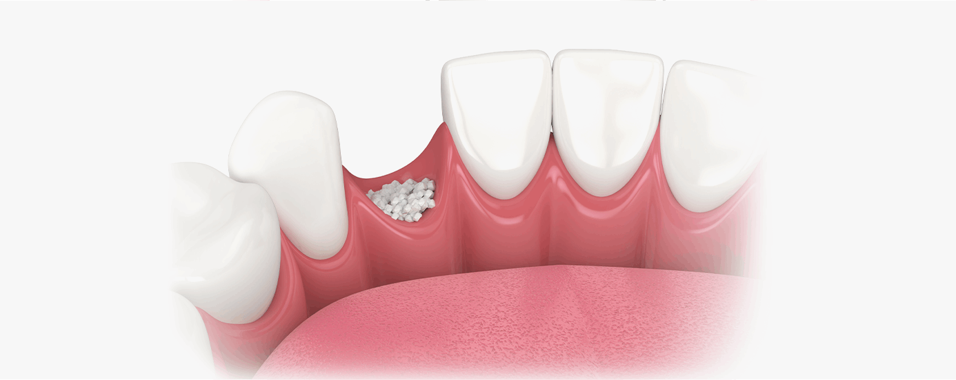 전신질환 임플란트
