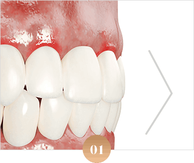 치아 돌출이 심한 경우